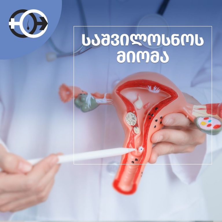 საშვილოსნოს მიომა